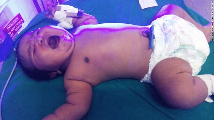 Teen delivers 15-pound baby in India